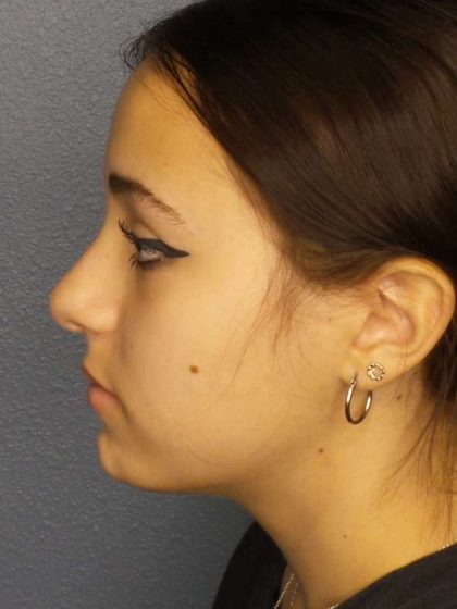 Rhinoplasty Before & After Patient #9794