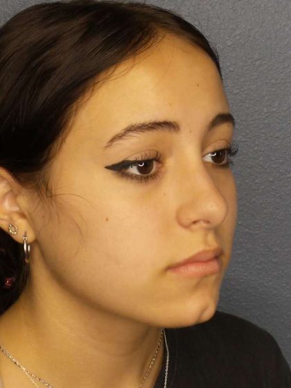Rhinoplasty Before & After Patient #9794