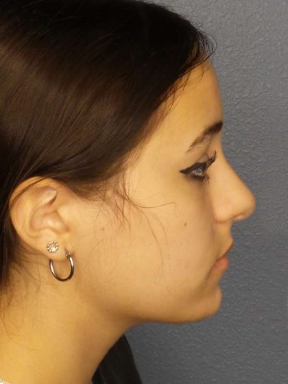 Rhinoplasty Before & After Patient #9794