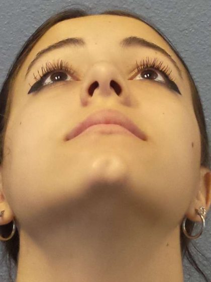 Rhinoplasty Before & After Patient #9794