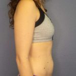 Trusculpt Before & After Patient #10261