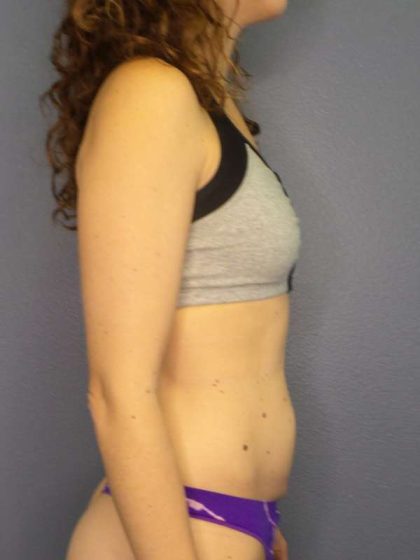 Trusculpt Before & After Patient #10261