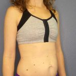 Trusculpt Before & After Patient #10261