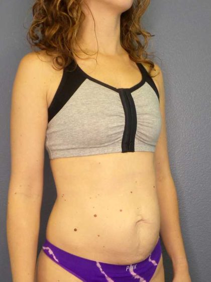 Trusculpt Before & After Patient #10261