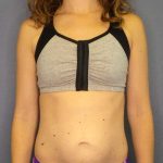 Trusculpt Before & After Patient #10261