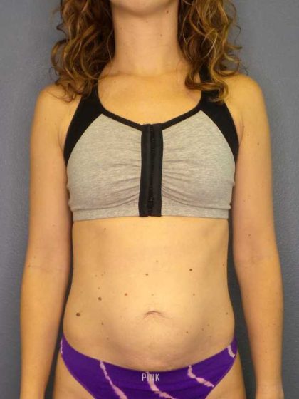 Trusculpt Before & After Patient #10261