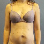 Trusculpt Before & After Patient #10261