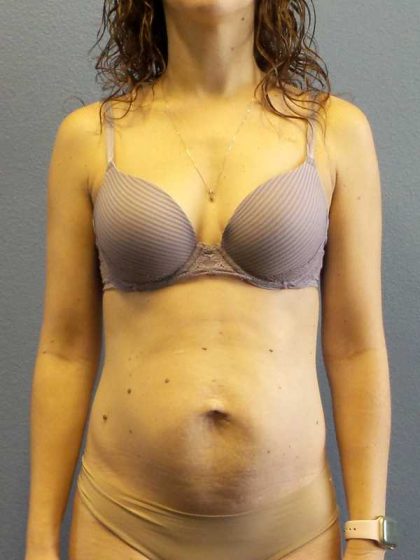 Trusculpt Before & After Patient #10261