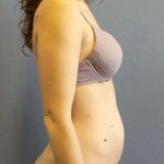Trusculpt Before & After Patient #10261