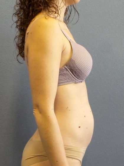 Trusculpt Before & After Patient #10261
