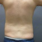 Male Liposuction Before & After Patient #12010