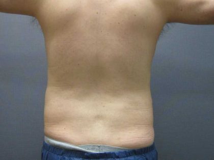 Male Liposuction Before & After Patient #12010