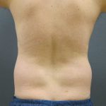 Male Liposuction Before & After Patient #12010