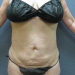 Liposuction Female Before & After Patient #11967