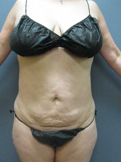Liposuction Female Before & After Patient #11967