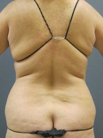 Liposuction Female Before & After Patient #11967