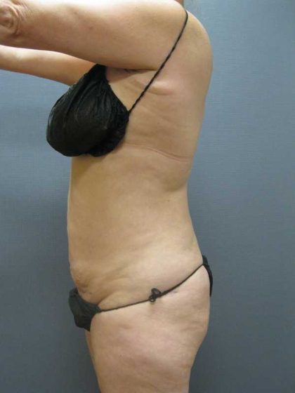 Liposuction Female Before & After Patient #11967