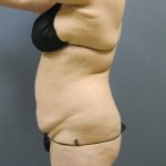 Liposuction Female Before & After Patient #11967