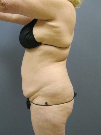 Liposuction Female Before & After Patient #11967