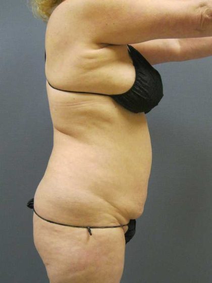 Liposuction Female Before & After Patient #11976