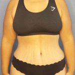 Abdominoplasty Before & After Patient #3493