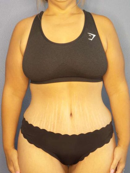 Abdominoplasty Before & After Patient #3493