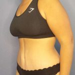 Abdominoplasty Before & After Patient #3493