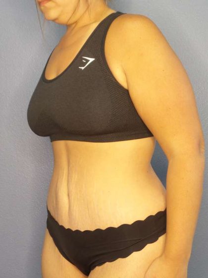 Abdominoplasty Before & After Patient #3493