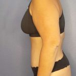 Abdominoplasty Before & After Patient #3493