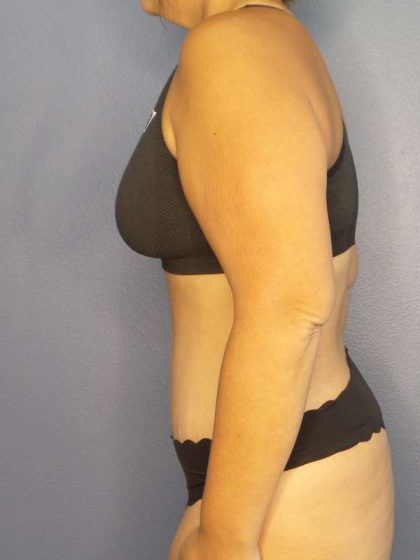 Abdominoplasty Before & After Patient #3493