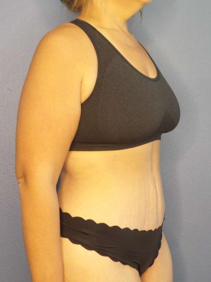 Abdominoplasty Before & After Patient #3493