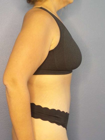 Abdominoplasty Before & After Patient #3493