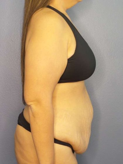 Abdominoplasty Before & After Patient #3493