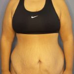 Abdominoplasty Before & After Patient #3493