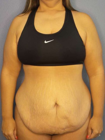 Abdominoplasty Before & After Patient #3493