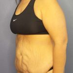 Abdominoplasty Before & After Patient #3493