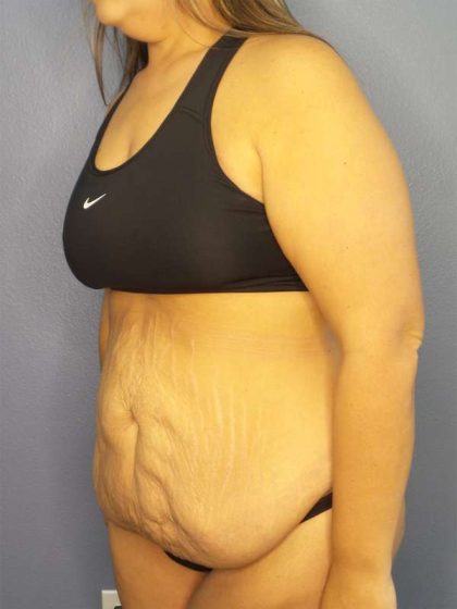 Abdominoplasty Before & After Patient #3493