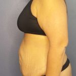 Abdominoplasty Before & After Patient #3493