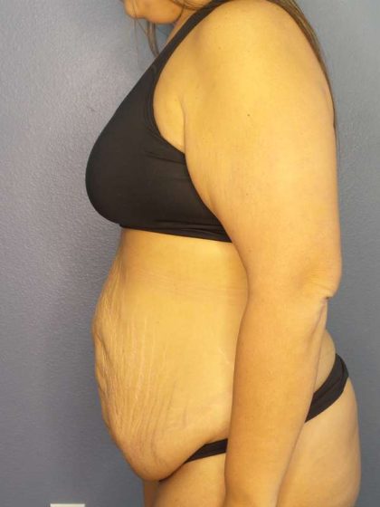 Abdominoplasty Before & After Patient #3493