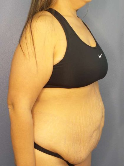 Abdominoplasty Before & After Patient #3493