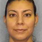 Liposuction of the Neck Before & After Patient #8286