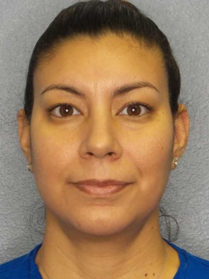 Liposuction of the Neck Before & After Patient #8286