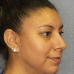 Liposuction of the Neck Before & After Patient #8286
