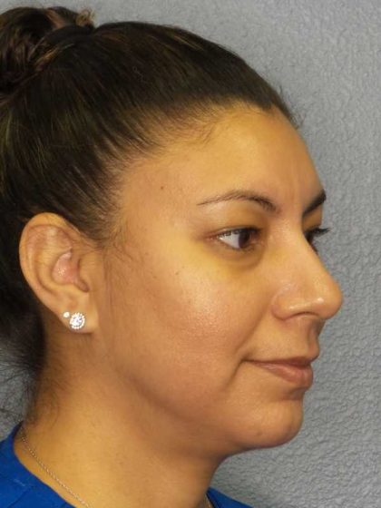 Liposuction of the Neck Before & After Patient #8286
