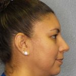 Liposuction of the Neck Before & After Patient #8286