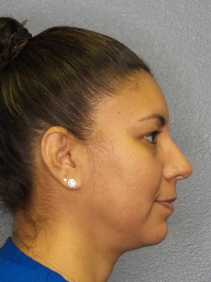 Liposuction of the Neck Before & After Patient #8286