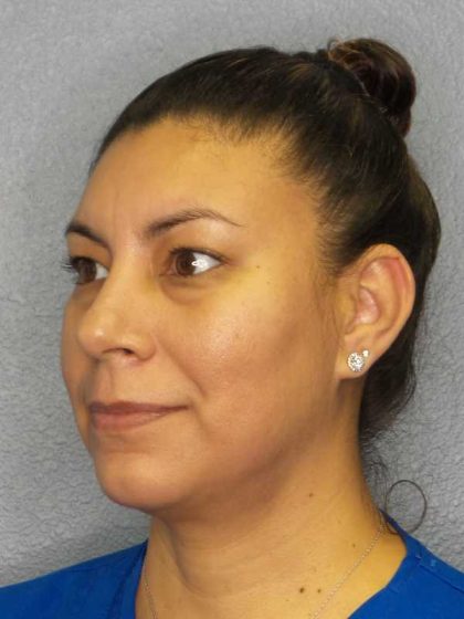 Liposuction of the Neck Before & After Patient #8286