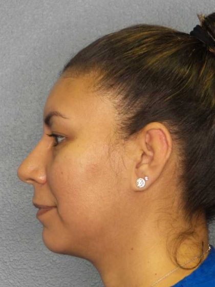 Liposuction of the Neck Before & After Patient #8286