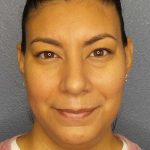 Liposuction of the Neck Before & After Patient #8286