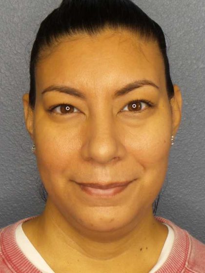 Liposuction of the Neck Before & After Patient #8286